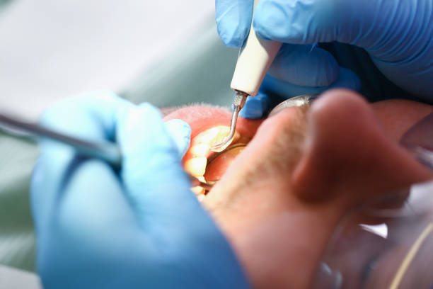 Best Emergency Treatment for Dental Infections or Abscesses in Cutchogue, NY