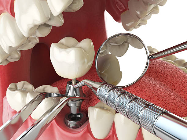 Best Emergency Tooth Extraction in Cutchogue, NY